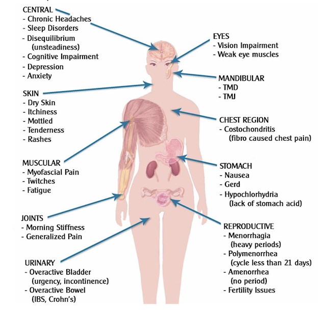 Pix 10 Fibro-Pain-Areas all Fiona.jpg